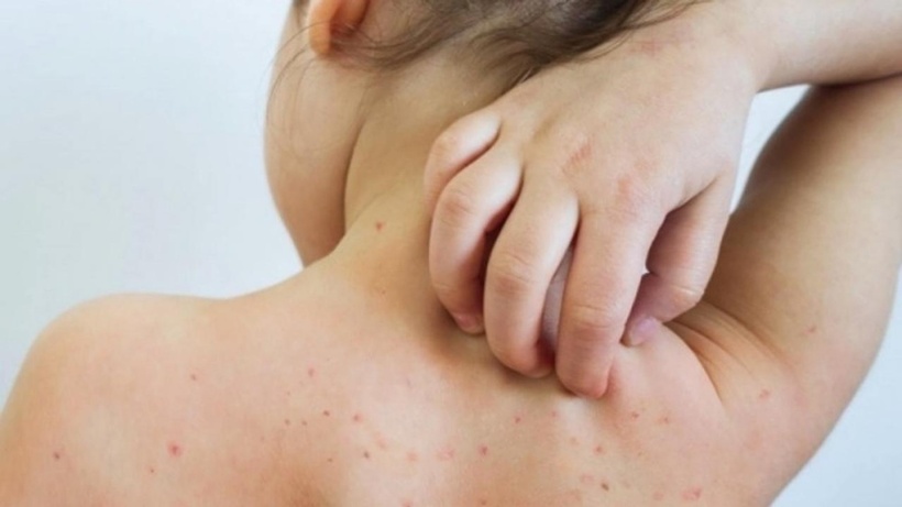 Một ca rubella vừa phát hiện: Bố mẹ chủ quan, trẻ lãnh hậu quả mot ca rubella vua phat hien bo me chu quan tre lanh hau qua