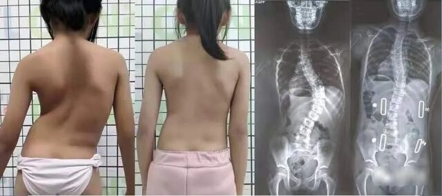 Cột sống của nữ sinh 16 tuổi cong gập 45 độ! Bác sĩ: Cứ 20 trẻ thì có 1 trẻ bị 1 Cột sống của nữ sinh 16 tuổi cong gập 45 độ! Bác sĩ: Cứ 20 trẻ thì có 1 trẻ bị