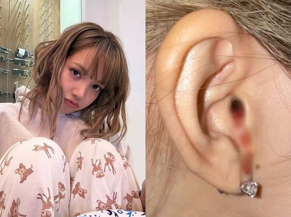 "Máu nhỏ giọt từ tai tôi", tiết lộ của Lisa (BlackPink) khiến nhiều người lo lắng: Chuyên gia chỉ ra nguyên nhân 1 "Máu nhỏ giọt từ tai tôi", tiết lộ của Lisa (BlackPink) khiến nhiều người lo lắng: Chuyên gia chỉ ra nguyên nhân