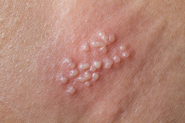 Mụn cóc sinh dục là gì, tiêm vắc xin HPV loại nào mới phòng chống được?